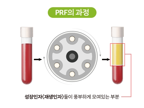 자가혈 PRF 임플란트 시술 과정 2단계